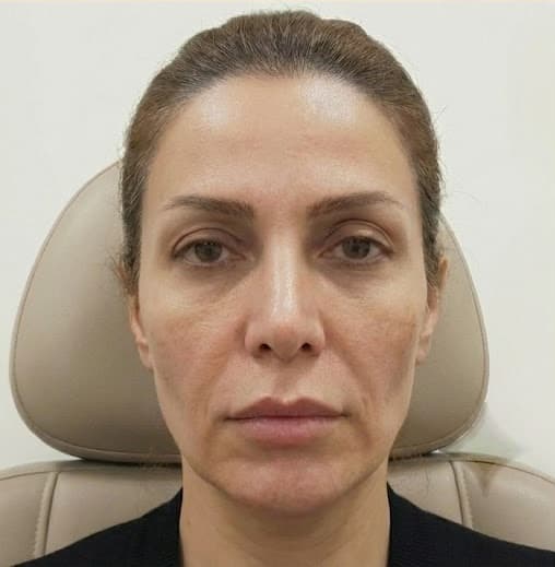 درمان‌های زیبایی غیرجراحی before treatment result at IranElaj